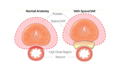 Mater-Private-SpaceOAR-hydrogel_illustration Mater-Private-SpaceOAR-hydrogel_illustration