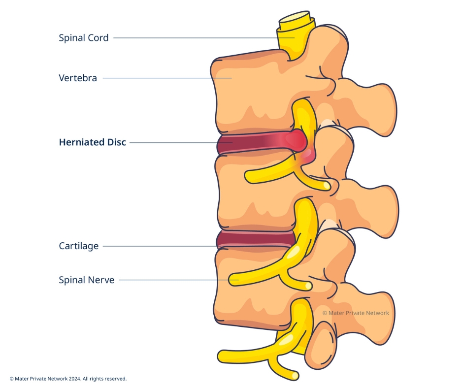 Herniated disc