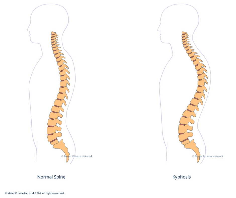 Kyphosis