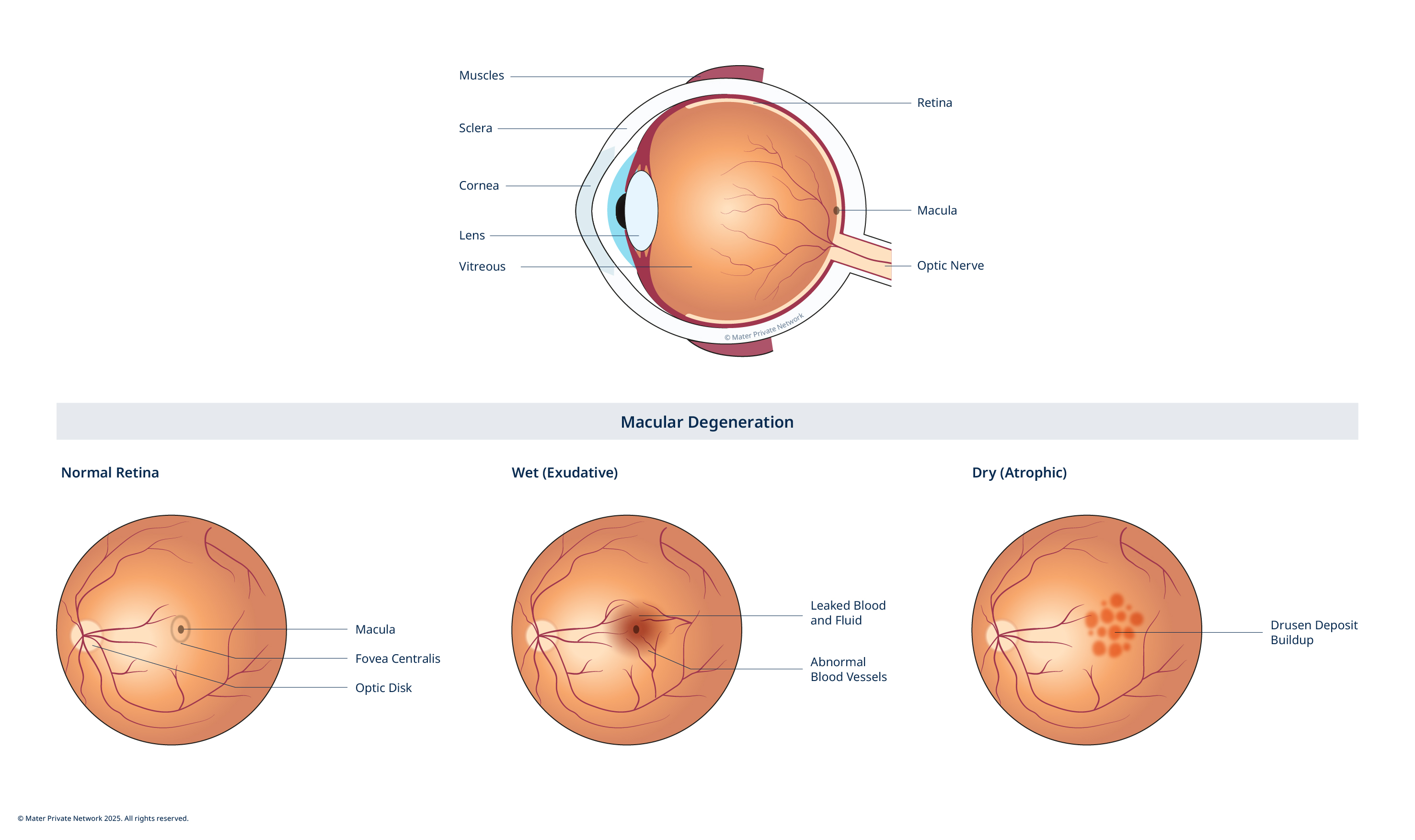 Macular Degeneration
