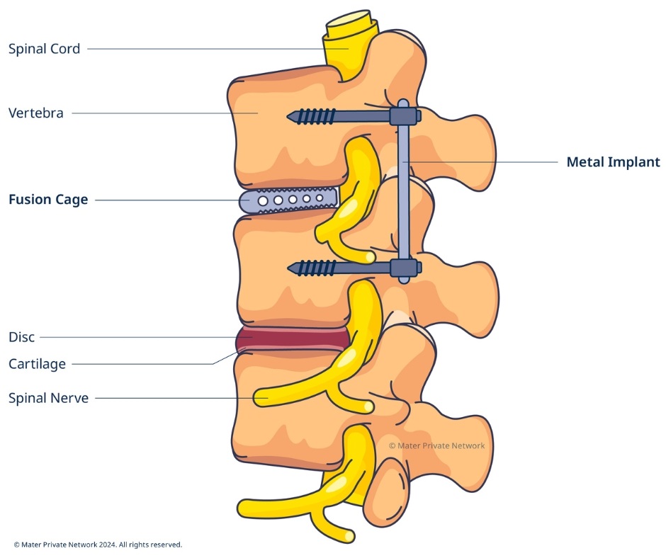 Metal implant & cage